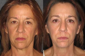 Eyelid lift